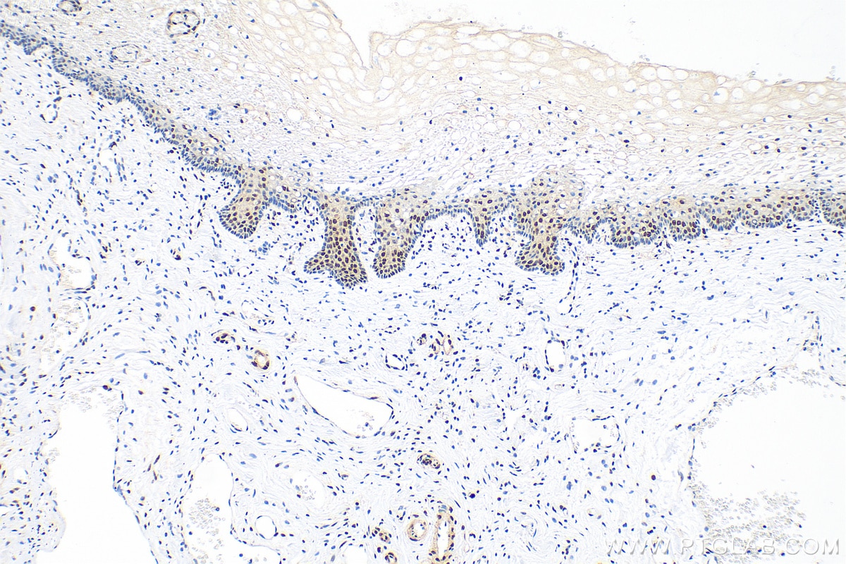 Immunohistochemistry (IHC) staining of human cervical cancer tissue using CREB1 Polyclonal antibody (12208-1-AP)