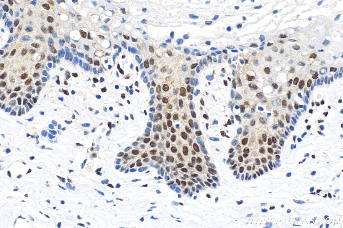 Immunohistochemistry (IHC) staining of human cervical cancer tissue using CREB1 Polyclonal antibody (12208-1-AP)