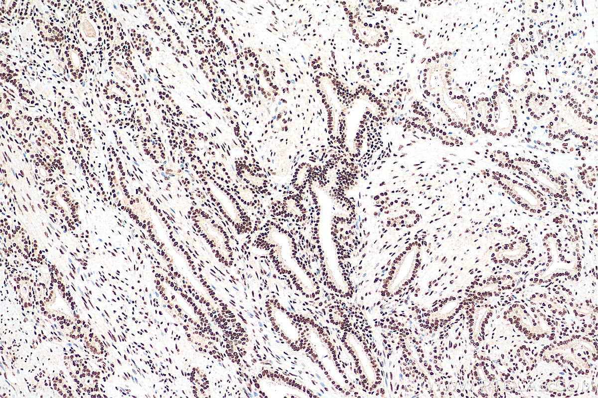 Immunohistochemistry (IHC) staining of human prostate cancer tissue using CREB1 Monoclonal antibody (67927-1-Ig)