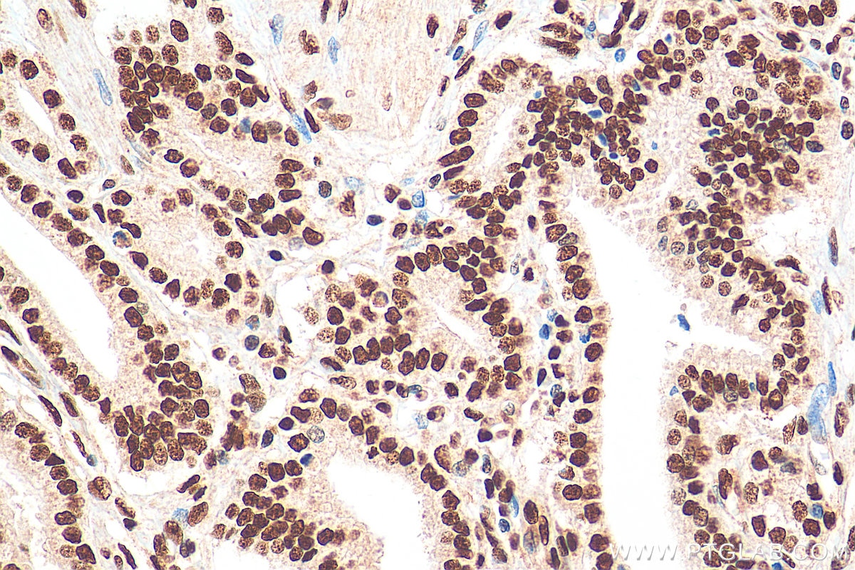 IHC staining of human prostate cancer using 67927-1-Ig