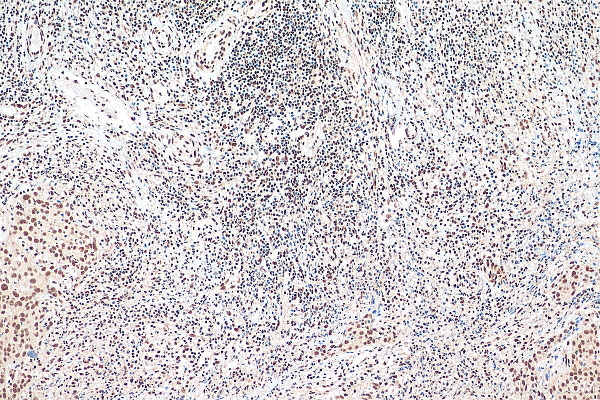 Immunohistochemistry (IHC) staining of human cervical cancer tissue using CREB1 Monoclonal antibody (67927-1-Ig)