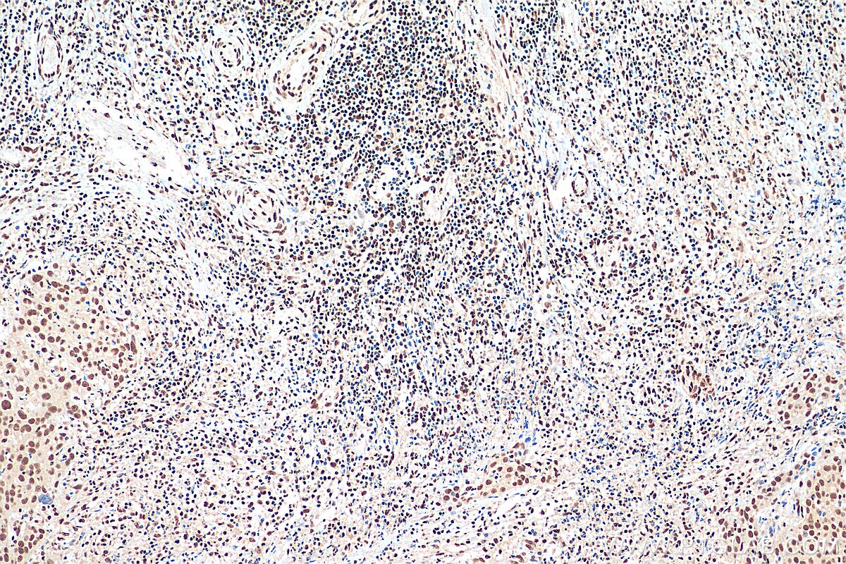 IHC staining of human cervical cancer using 67927-1-Ig