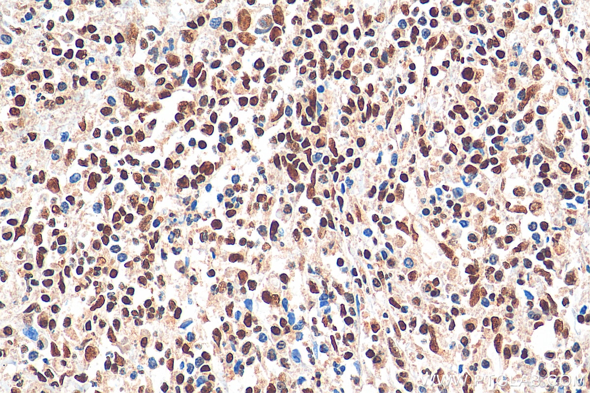 IHC staining of human cervical cancer using 67927-1-Ig