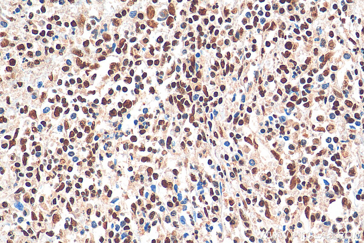 Immunohistochemistry (IHC) staining of human cervical cancer tissue using CREB1 Monoclonal antibody (67927-1-Ig)