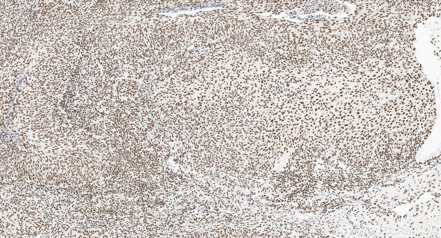 Immunohistochemistry (IHC) staining of human cervical cancer tissue using CREB1 Recombinant monoclonal antibody (88035-1-RR)