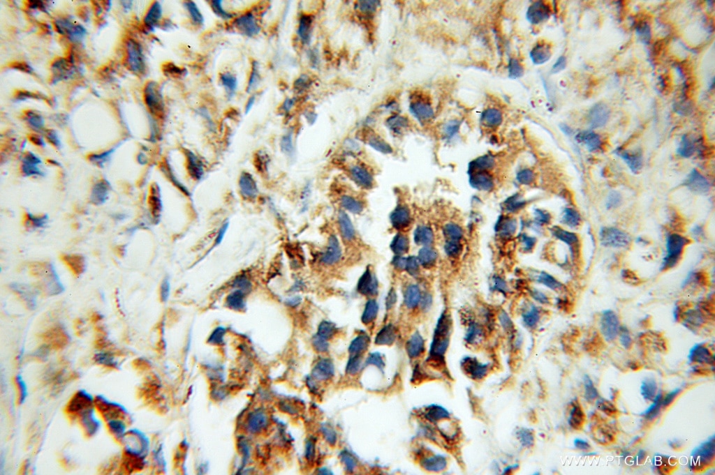 Immunohistochemistry (IHC) staining of human prostate cancer tissue using CREB3 Polyclonal antibody (11275-1-AP)