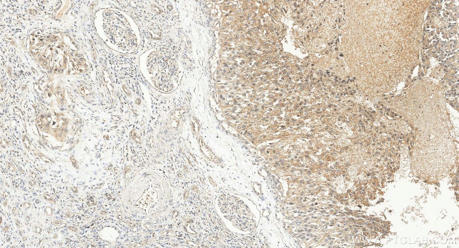 Immunohistochemistry (IHC) staining of human renal cell carcinoma tissue using CREB3L1,OASIS Polyclonal antibody (11235-2-AP)
