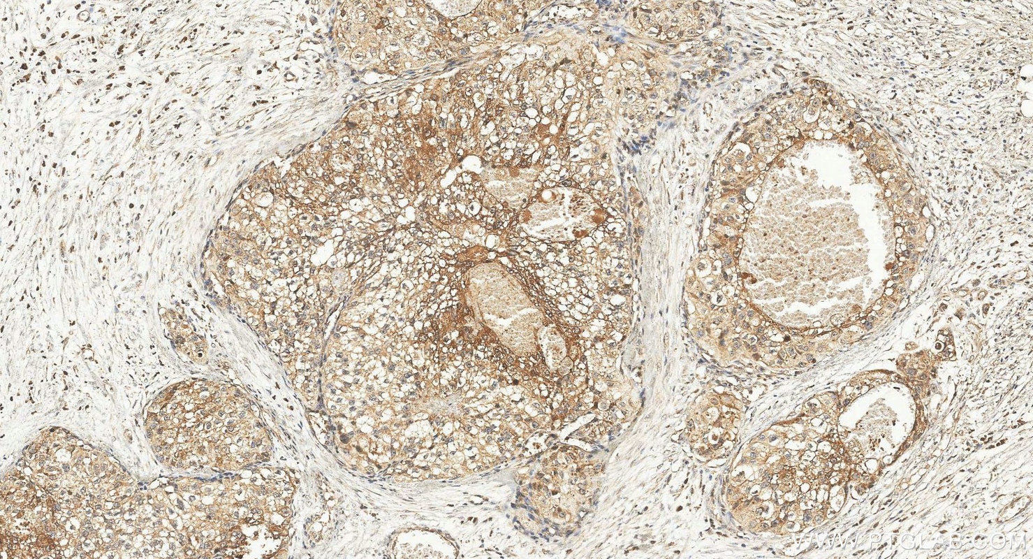 Immunohistochemistry (IHC) staining of human renal cell carcinoma tissue using CREB3L1,OASIS Polyclonal antibody (11235-2-AP)