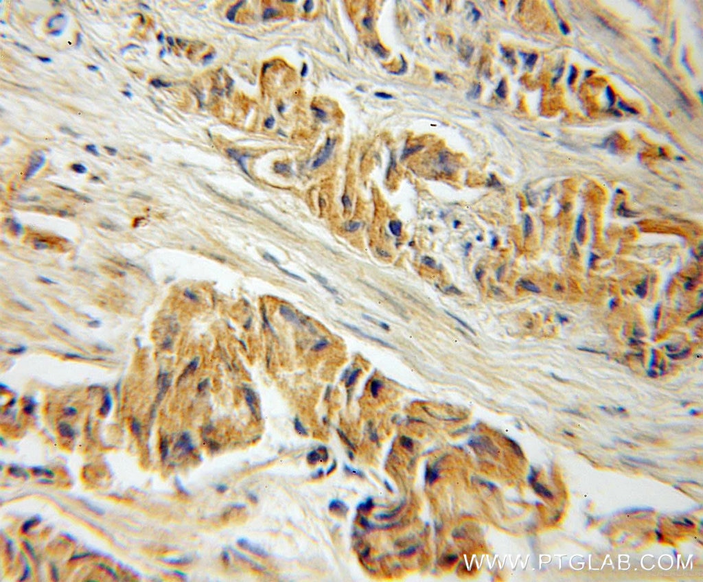 Immunohistochemistry (IHC) staining of human prostate cancer tissue using CREB3L1,OASIS Polyclonal antibody (11235-2-AP)