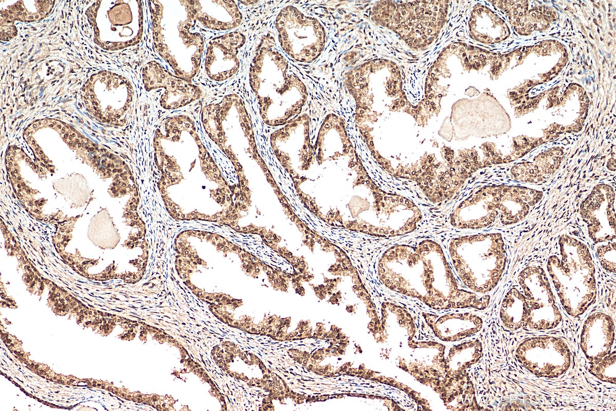 Immunohistochemistry (IHC) staining of human prostate cancer tissue using CREBBP Polyclonal antibody (22277-1-AP)