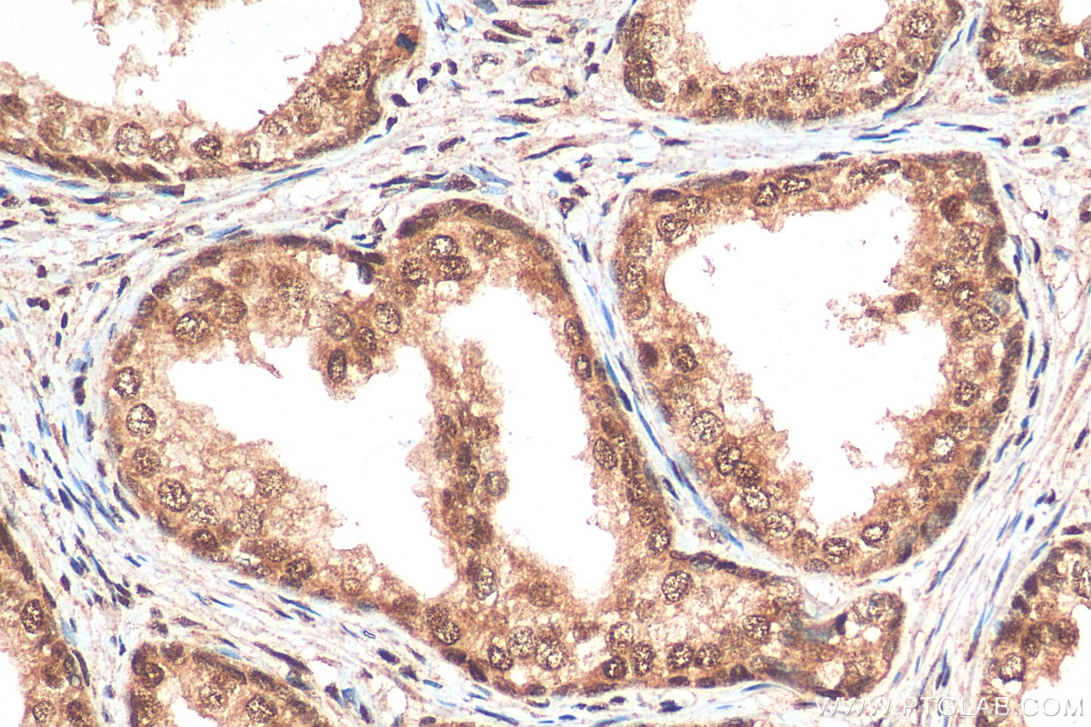 IHC staining of human prostate cancer using 22277-1-AP