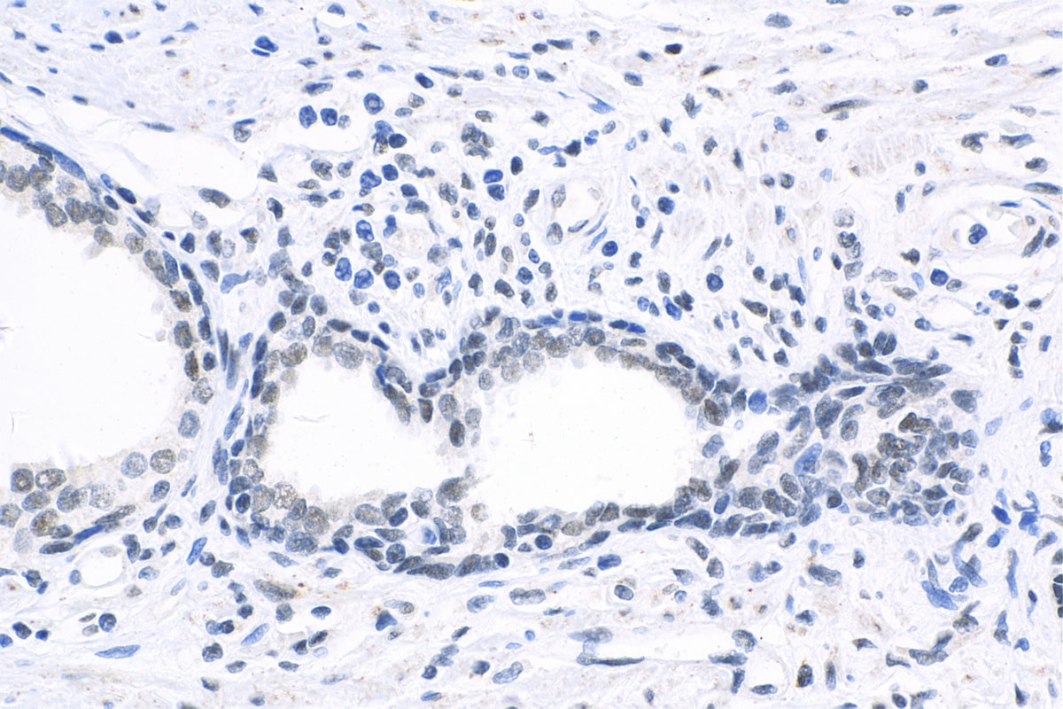 Immunohistochemistry (IHC) staining of human prostate cancer tissue using CREM Polyclonal antibody (12131-1-AP)