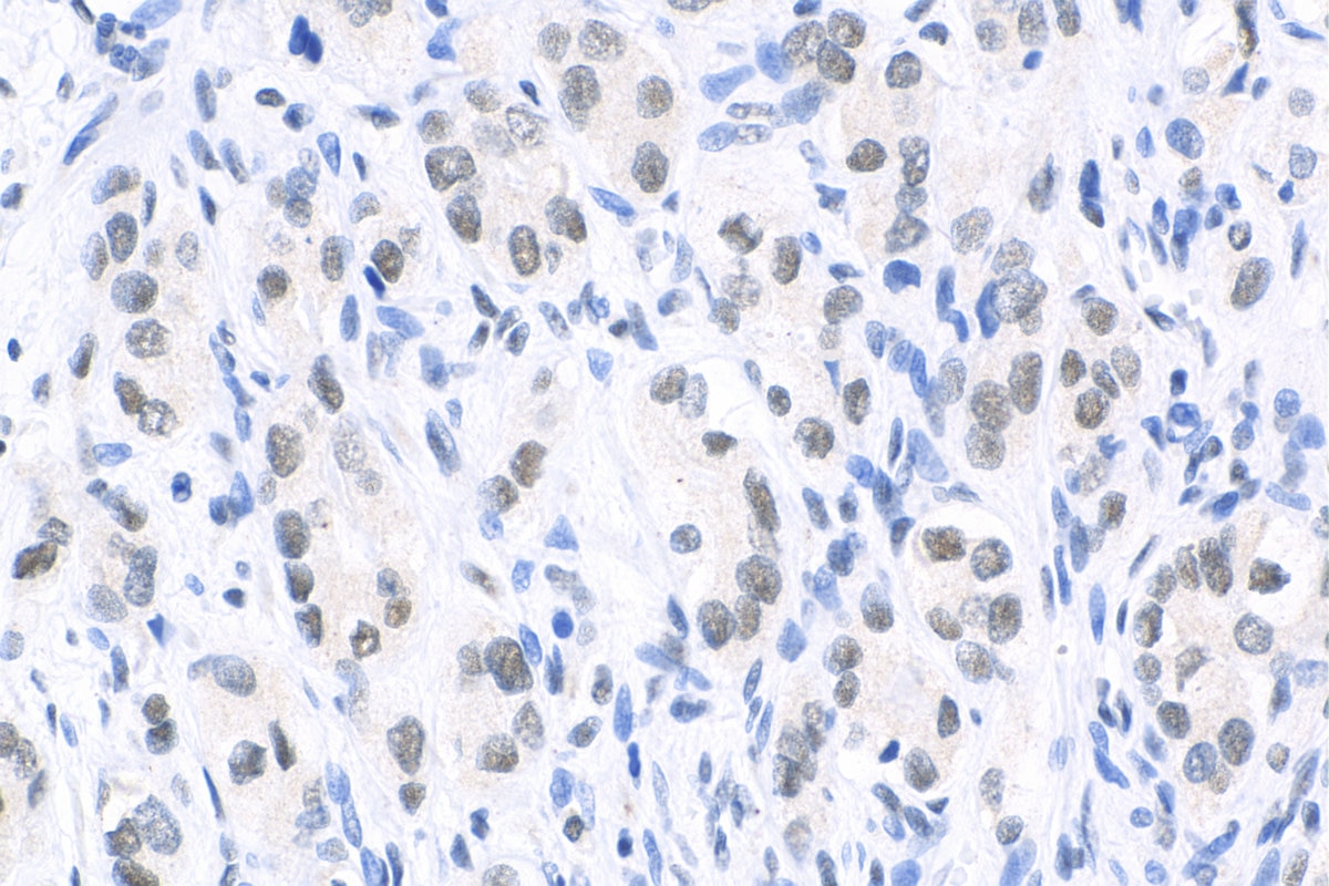 Immunohistochemistry (IHC) staining of human prostate cancer tissue using CREM Polyclonal antibody (12131-1-AP)
