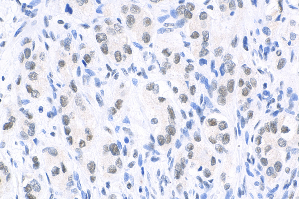 IHC staining of human prostate cancer using 12131-1-AP