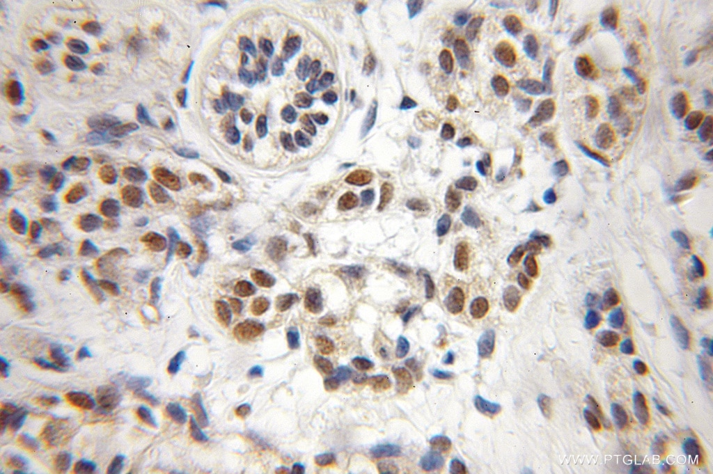 Immunohistochemistry (IHC) staining of human breast cancer tissue using CREST Polyclonal antibody (12439-1-AP)