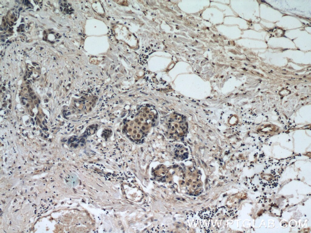 Immunohistochemistry (IHC) staining of human breast cancer tissue using CREST Polyclonal antibody (12439-1-AP)