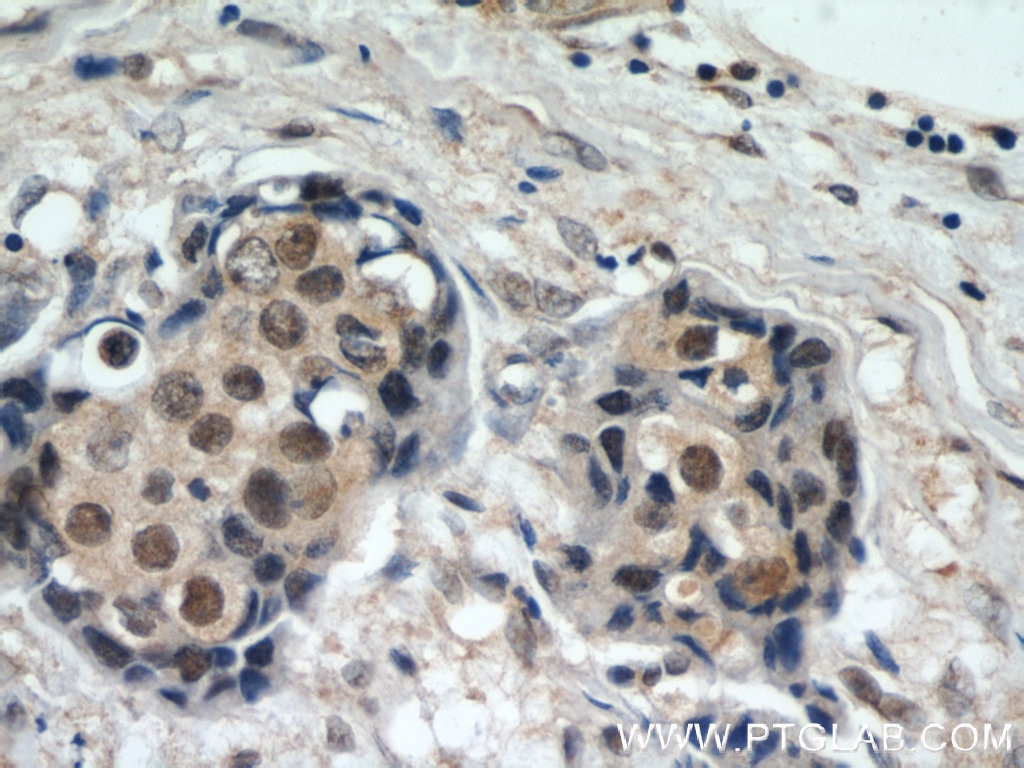 Immunohistochemistry (IHC) staining of human breast cancer tissue using CREST Polyclonal antibody (12439-1-AP)