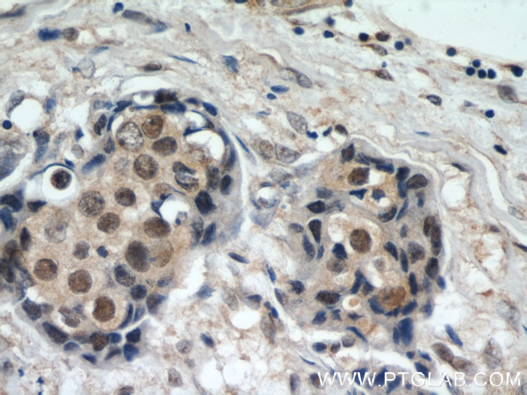 IHC staining of human breast cancer using 12439-1-AP