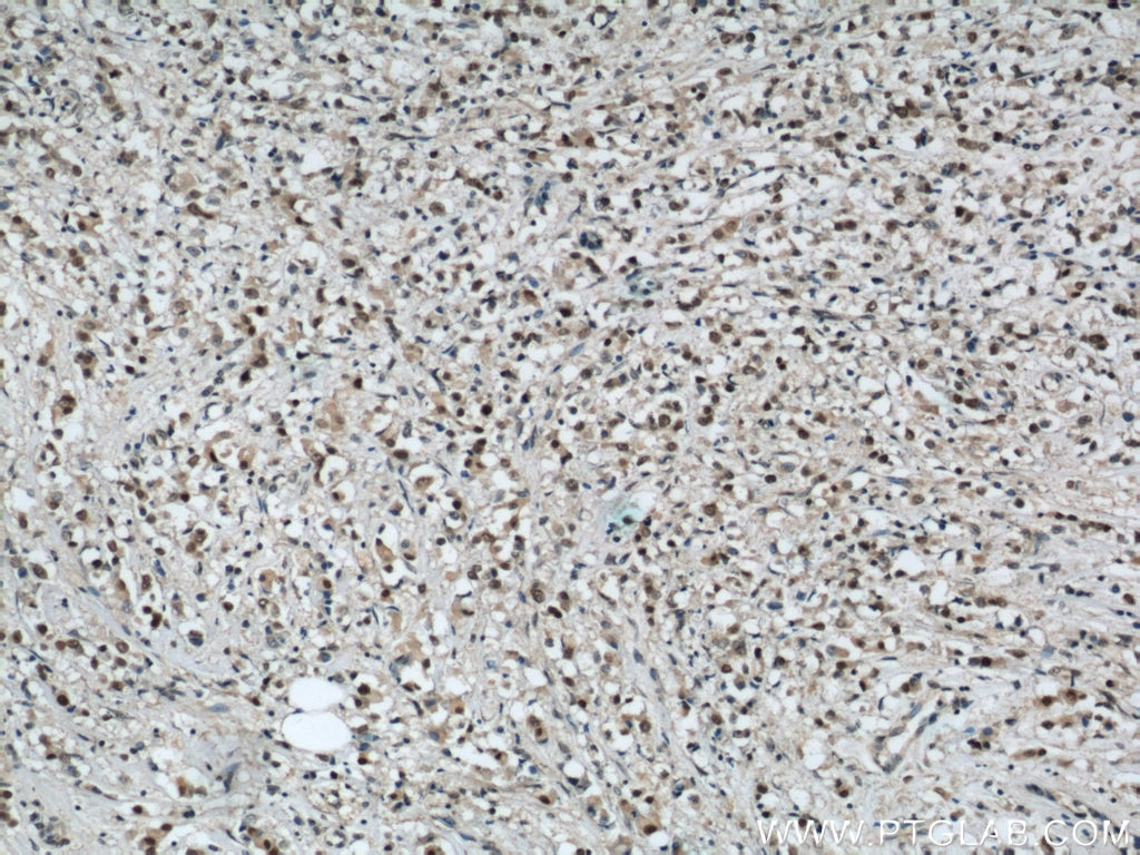 IHC staining of human breast cancer using 12439-1-AP