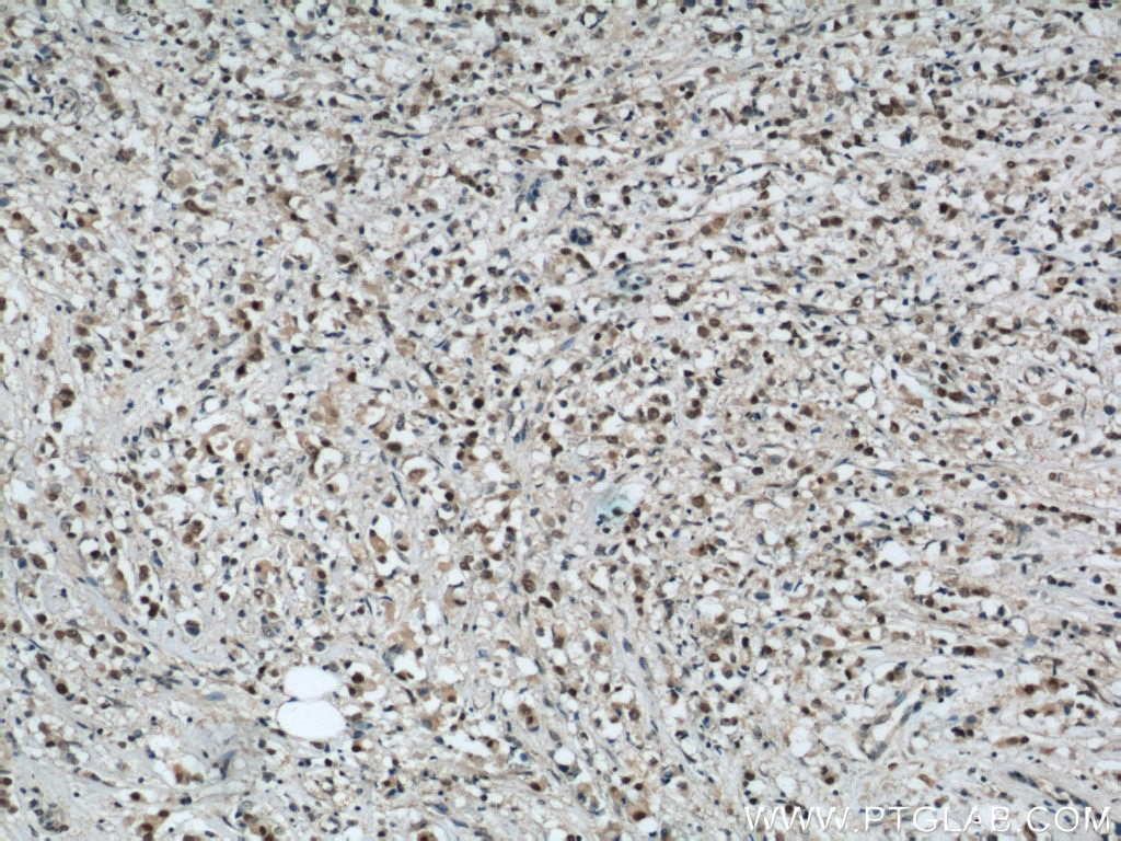 Immunohistochemistry (IHC) staining of human breast cancer tissue using CREST Polyclonal antibody (12439-1-AP)