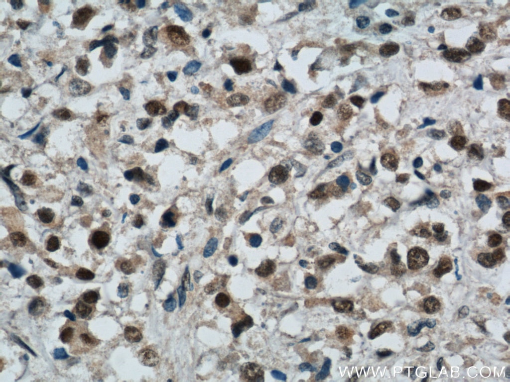 Immunohistochemistry (IHC) staining of human breast cancer tissue using CREST Polyclonal antibody (12439-1-AP)