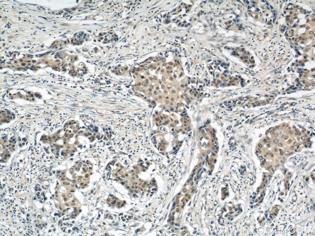 Immunohistochemistry (IHC) staining of human breast cancer tissue using CREST Polyclonal antibody (12439-1-AP)