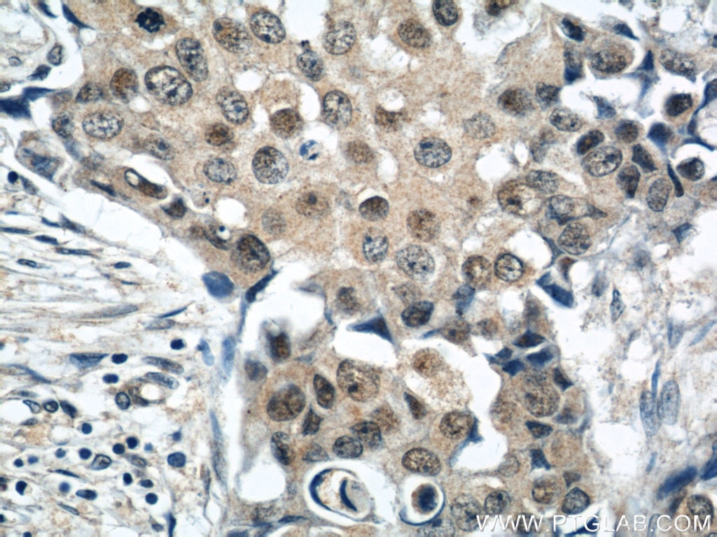 Immunohistochemistry (IHC) staining of human breast cancer tissue using CREST Polyclonal antibody (12439-1-AP)