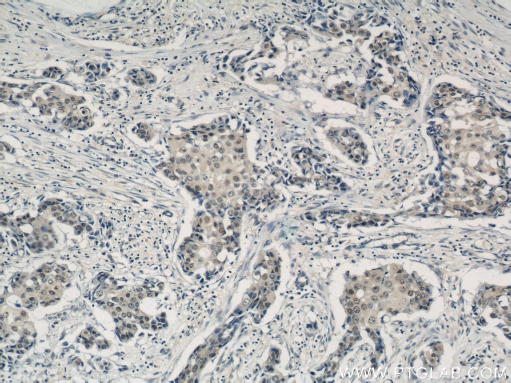 IHC staining of human breast cancer using 12439-1-AP