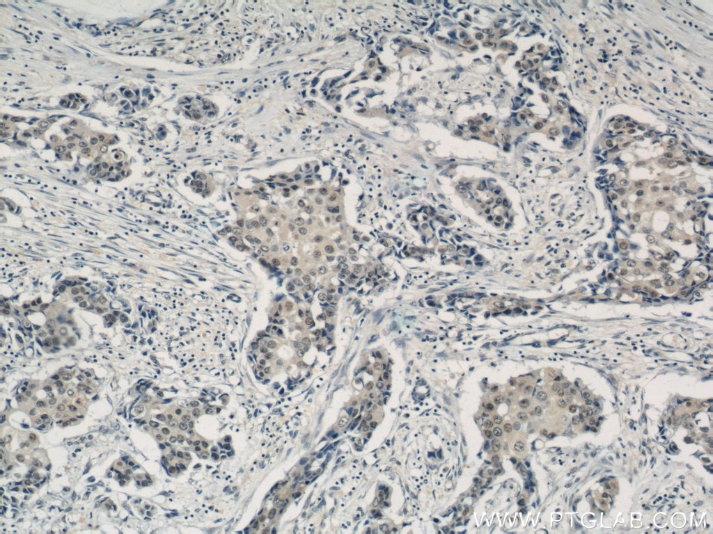 Immunohistochemistry (IHC) staining of human breast cancer tissue using CREST Polyclonal antibody (12439-1-AP)