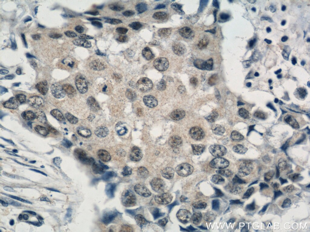 Immunohistochemistry (IHC) staining of human breast cancer tissue using CREST Polyclonal antibody (12439-1-AP)