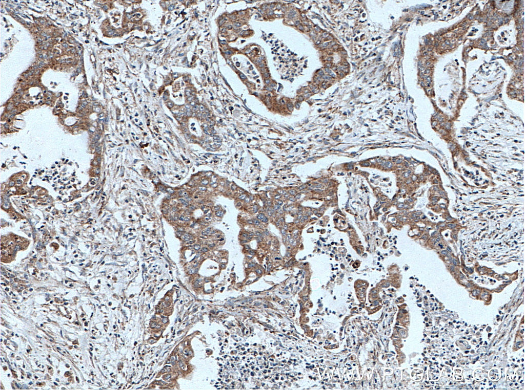 Immunohistochemistry (IHC) staining of human pancreas cancer tissue using CRH/CRF Polyclonal antibody (10944-1-AP)