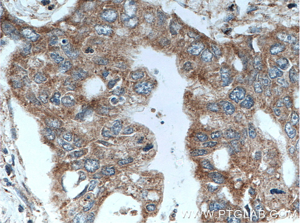 Immunohistochemistry (IHC) staining of human pancreas cancer tissue using CRH/CRF Polyclonal antibody (10944-1-AP)