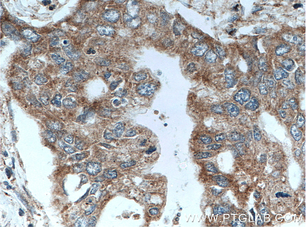 IHC staining of human pancreas cancer using 10944-1-AP