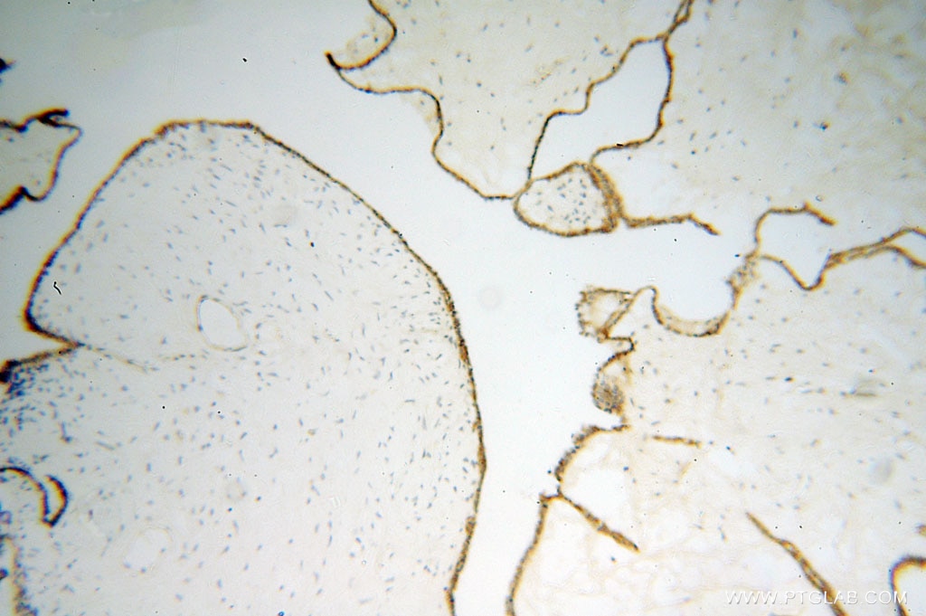 Immunohistochemistry (IHC) staining of human ovary tumor tissue using CRISP3 Polyclonal antibody (14843-1-AP)