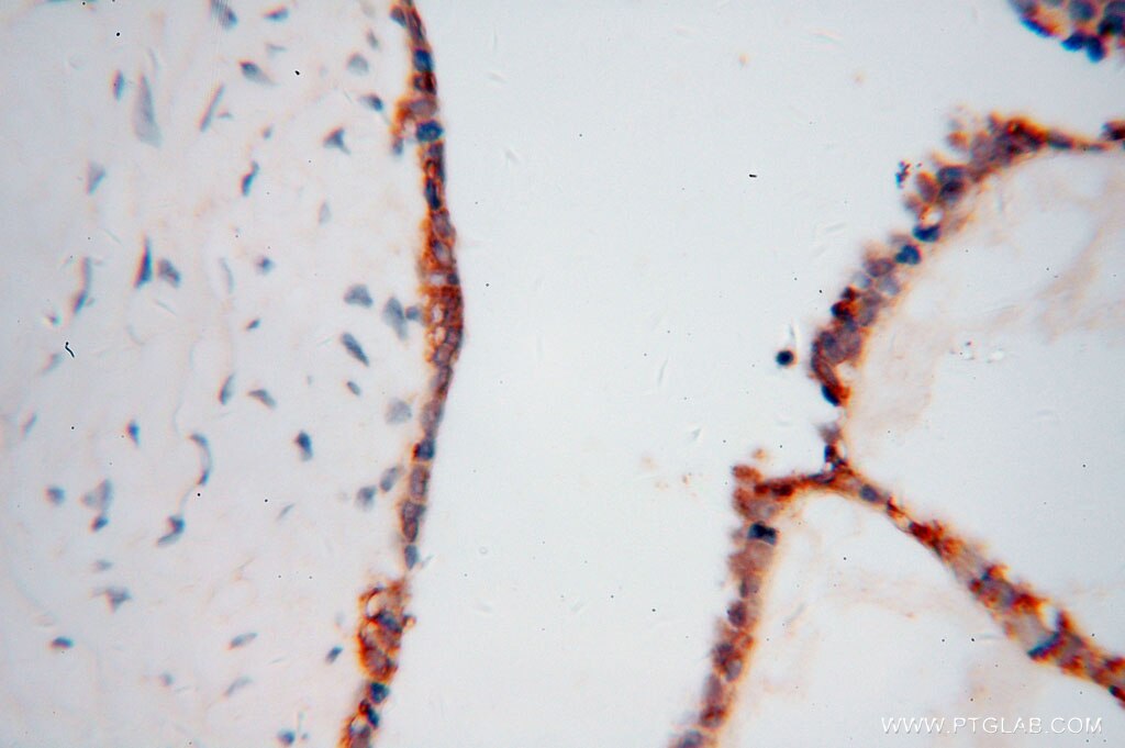 Immunohistochemistry (IHC) staining of human ovary tumor tissue using CRISP3 Polyclonal antibody (14843-1-AP)