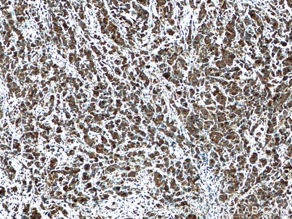 Immunohistochemistry (IHC) staining of human prostate cancer tissue using CRISP3 Polyclonal antibody (14847-1-AP)