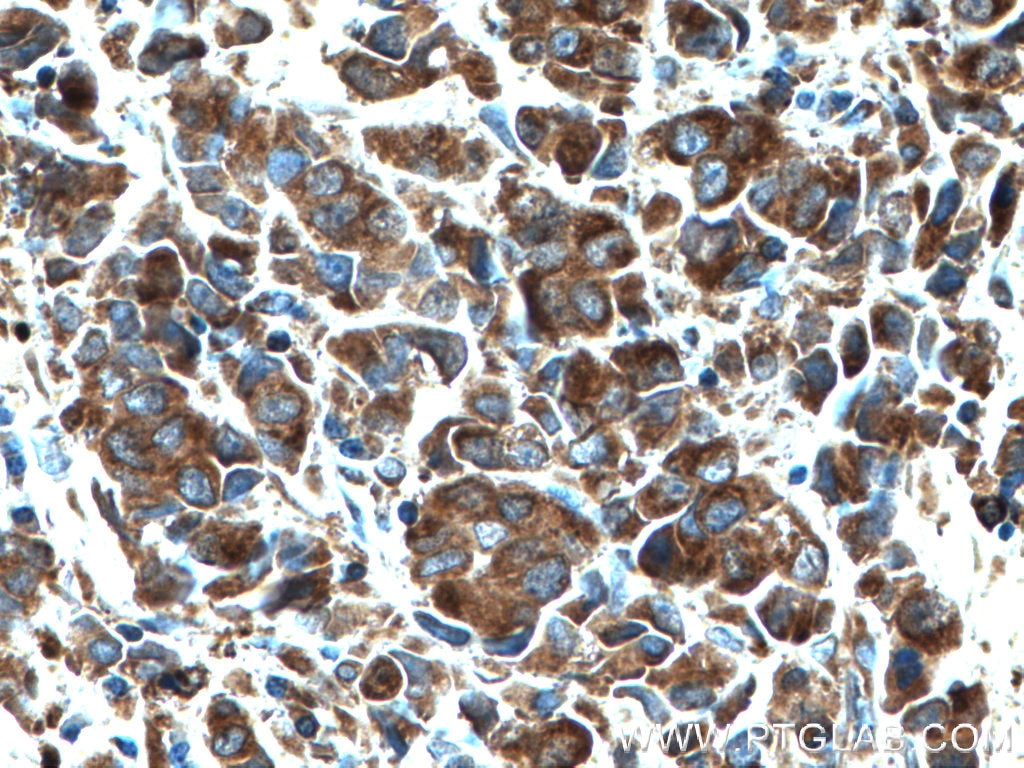 Immunohistochemistry (IHC) staining of human prostate cancer tissue using CRISP3 Polyclonal antibody (14847-1-AP)