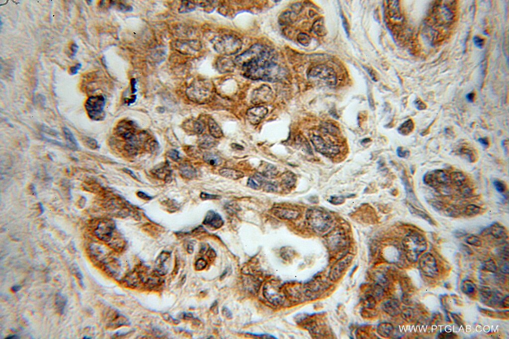 Immunohistochemistry (IHC) staining of human pancreas cancer tissue using CRISP3 Polyclonal antibody (51039-1-AP)