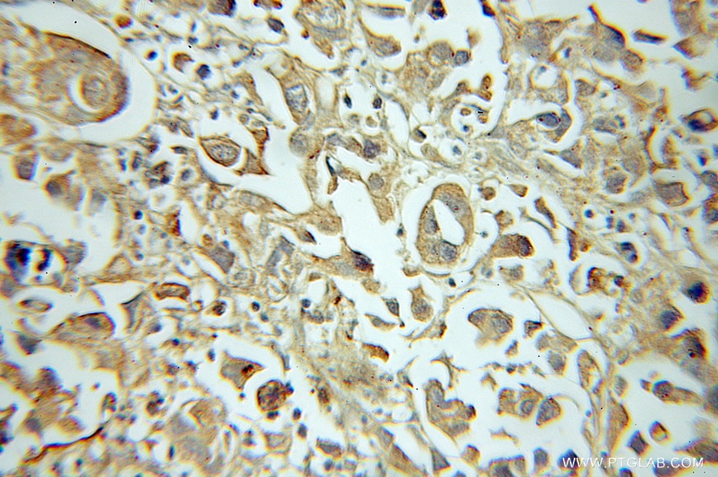 Immunohistochemistry (IHC) staining of human prostate cancer tissue using CRK Polyclonal antibody (10973-1-AP)