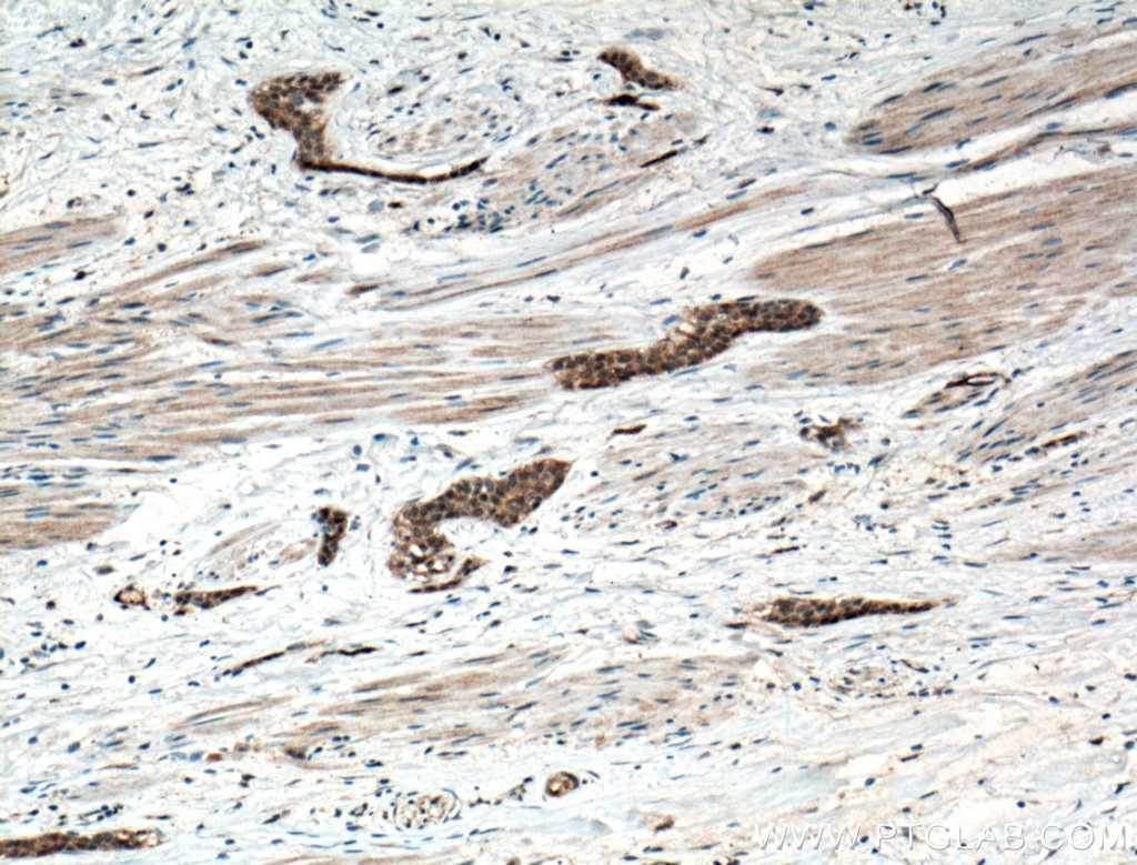 Immunohistochemistry (IHC) staining of human urothelial carcinoma tissue using CRK Polyclonal antibody (16685-1-AP)