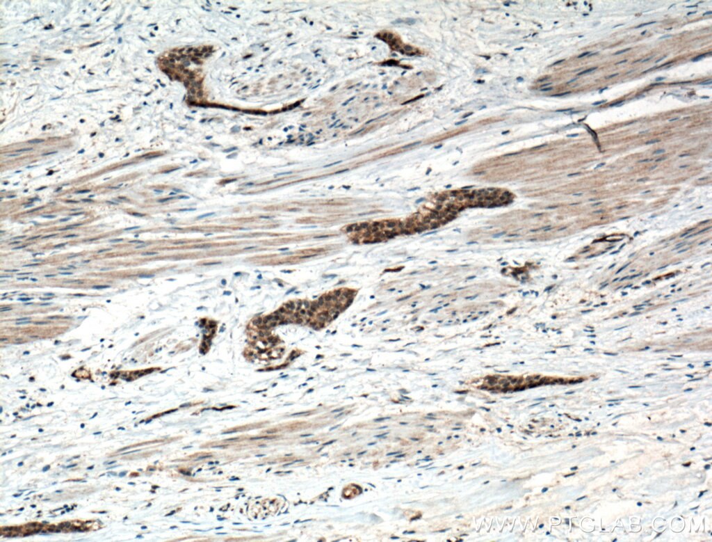 Immunohistochemistry (IHC) staining of human urothelial carcinoma tissue using CRK Polyclonal antibody (16685-1-AP)