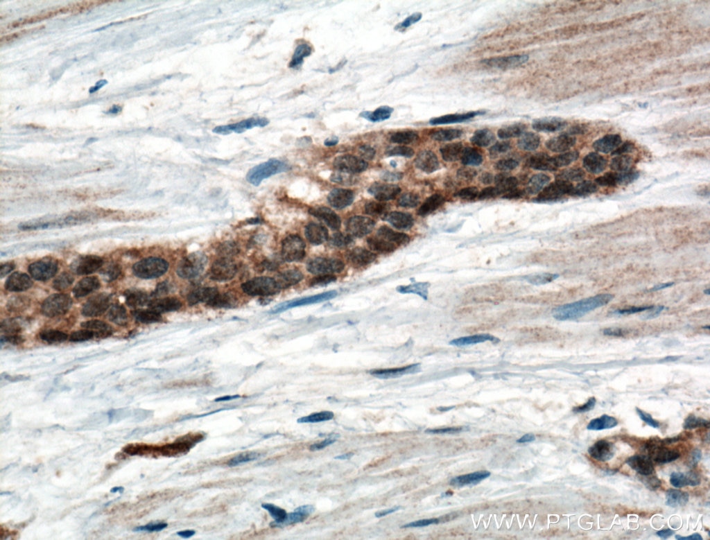 Immunohistochemistry (IHC) staining of human urothelial carcinoma tissue using CRK Polyclonal antibody (16685-1-AP)