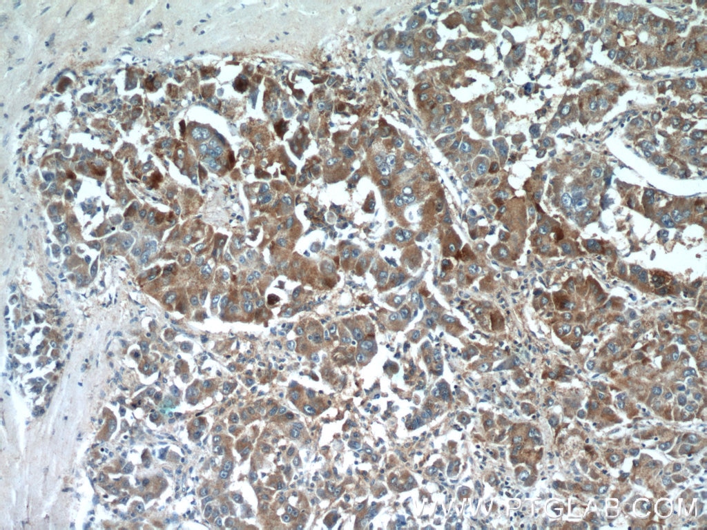 Immunohistochemistry (IHC) staining of human liver cancer tissue using CRLF1 Polyclonal antibody (17027-1-AP)