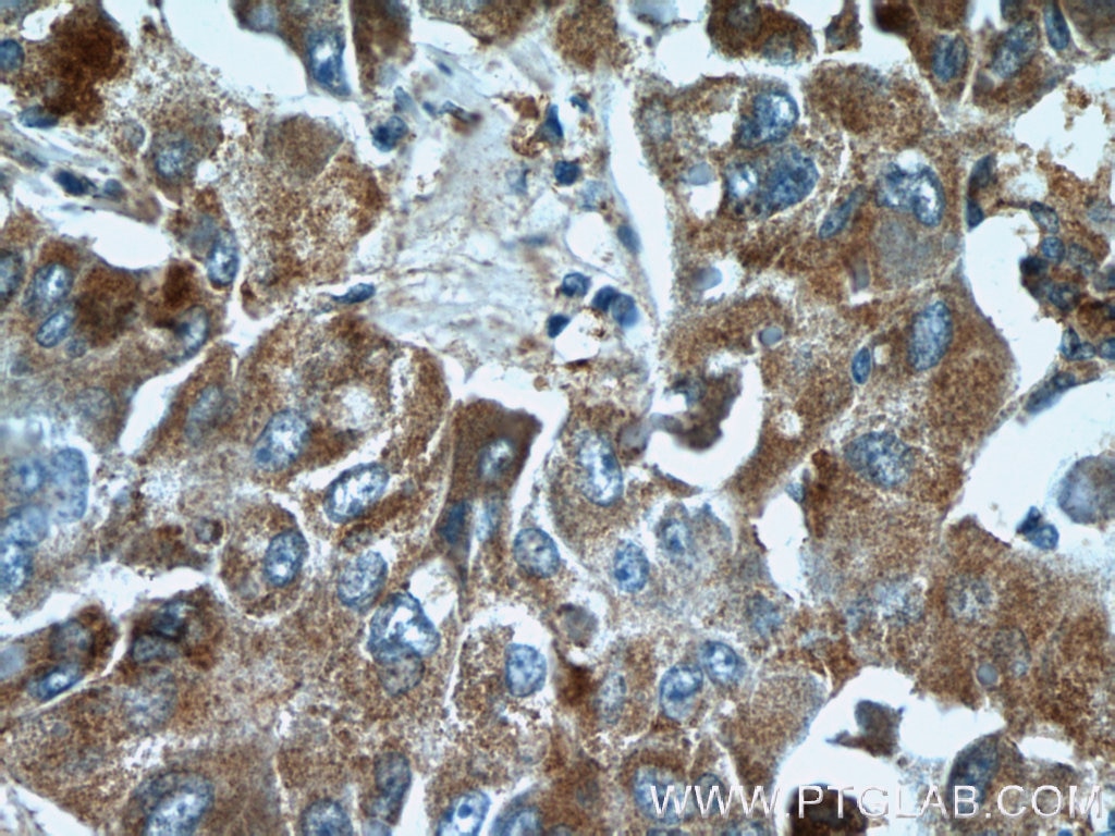 IHC staining of human liver cancer using 17027-1-AP