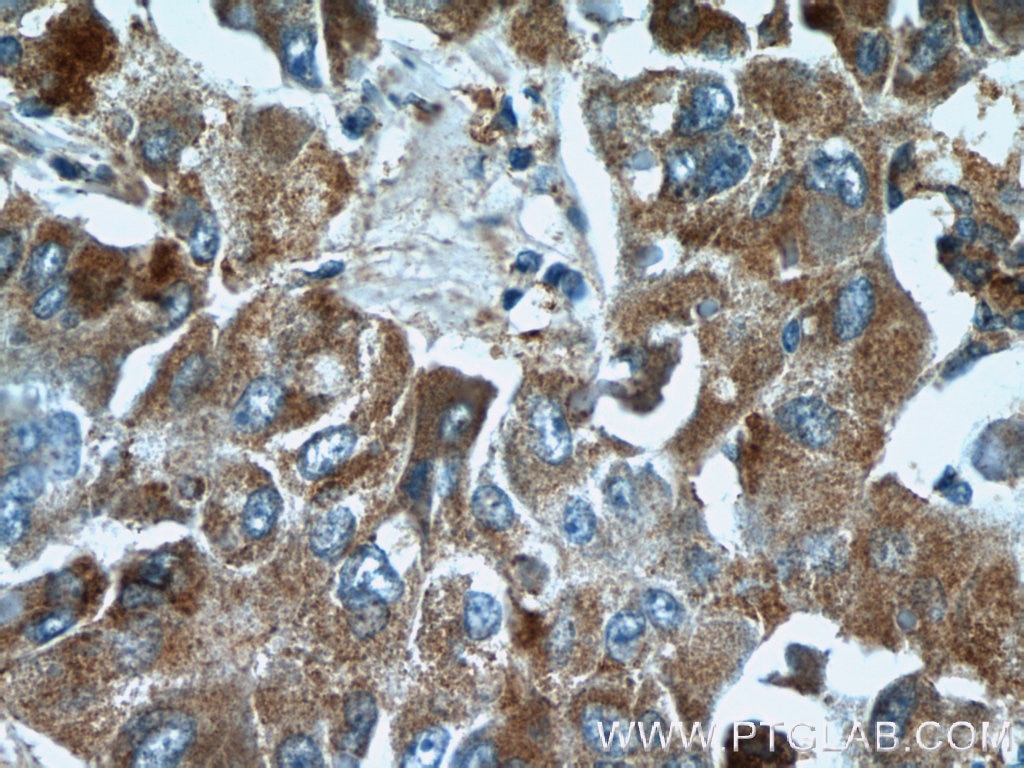 Immunohistochemistry (IHC) staining of human liver cancer tissue using CRLF1 Polyclonal antibody (17027-1-AP)