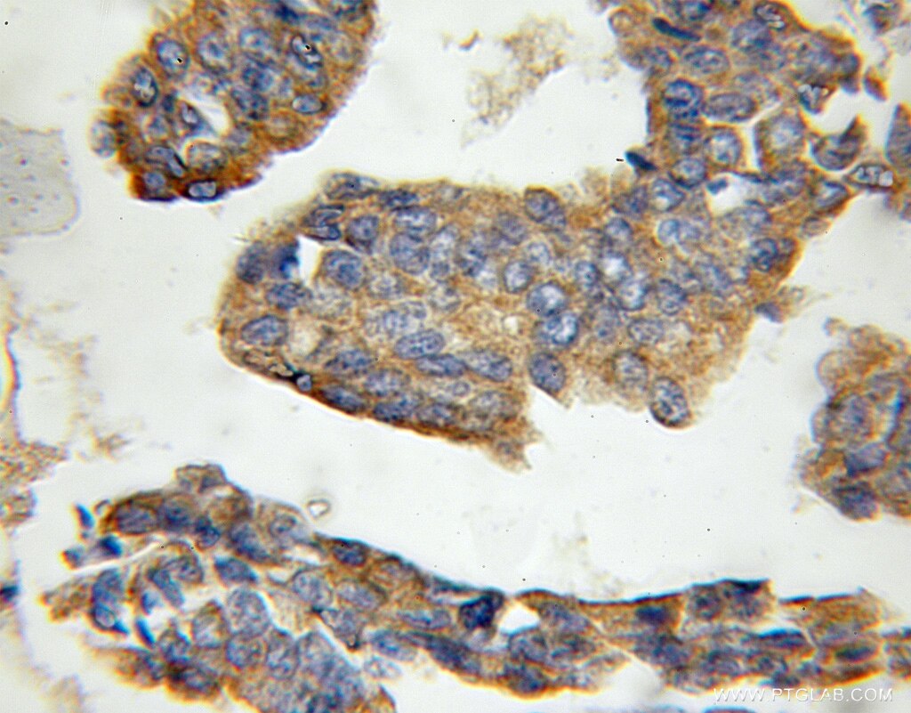 Immunohistochemistry (IHC) staining of human breast cancer tissue using CRLS1 Polyclonal antibody (51055-1-AP)