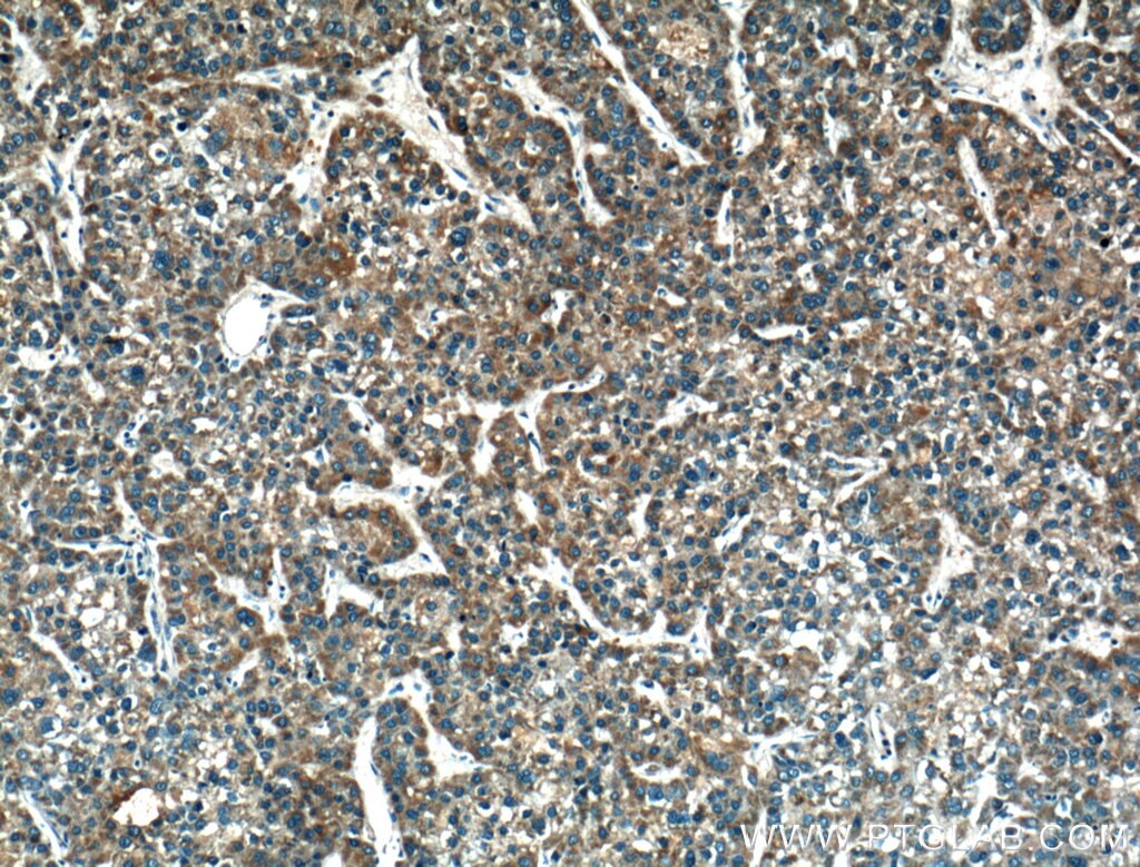 Immunohistochemistry (IHC) staining of human liver cancer tissue using CRLS1-Specific Polyclonal antibody (14845-1-AP)