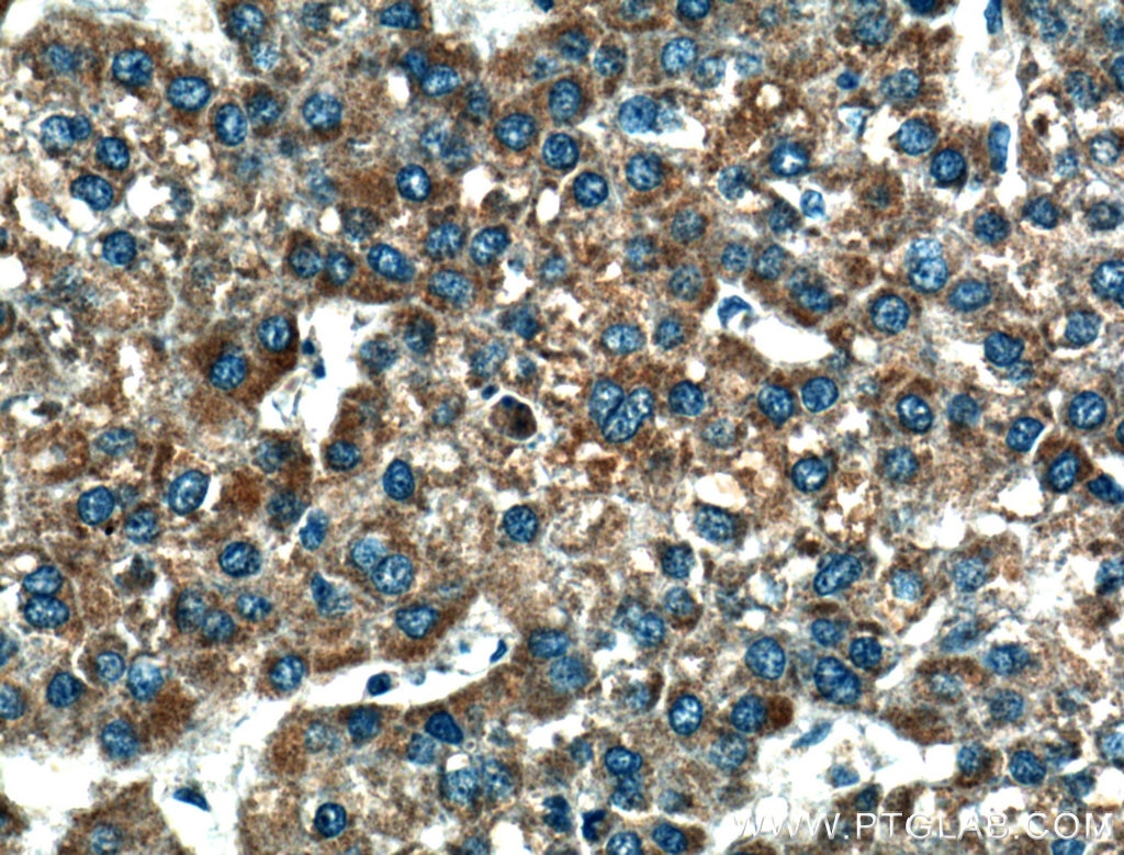 Immunohistochemistry (IHC) staining of human liver cancer tissue using CRLS1-Specific Polyclonal antibody (14845-1-AP)