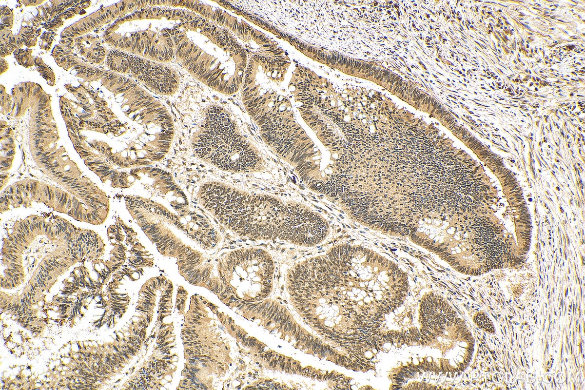 Immunohistochemistry (IHC) staining of human colon cancer tissue using CRM1 Polyclonal antibody (27917-1-AP)