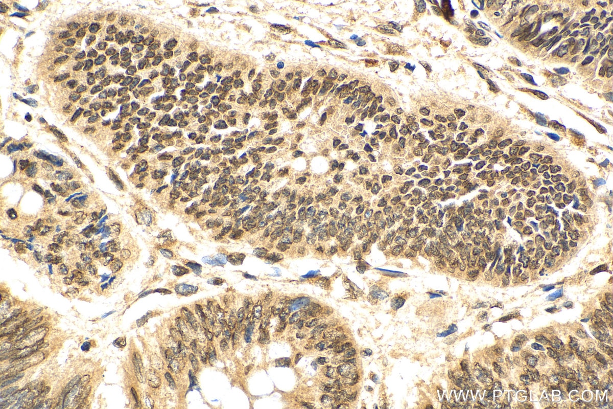 Immunohistochemistry (IHC) staining of human colon cancer tissue using CRM1 Polyclonal antibody (27917-1-AP)